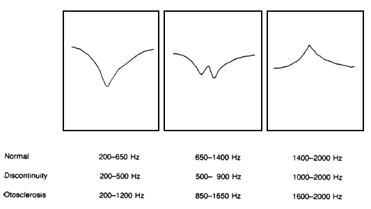 A diagram for plotting findings for tympanometry and acoustic