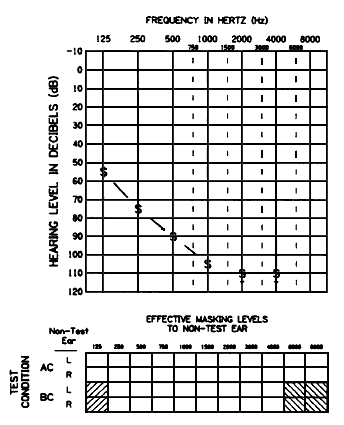 Acoustic reflex thresholds for pure tone stimuli (solid line) versus